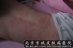 荨麻疹的症状和治疗