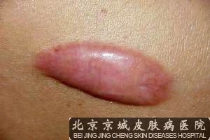 用激光可以治疗疤痕疙瘩吗