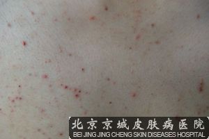 毛囊炎会传染吗