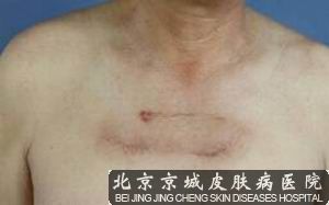 根治瘢痕疙瘩的方法
