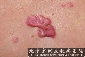 去除瘢痕疙瘩的*好方法