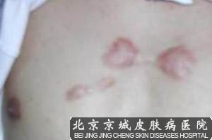 疤痕疙瘩治疗*新*佳方法