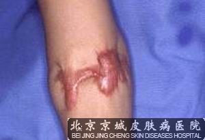 瘢痕疙瘩能治疗吗