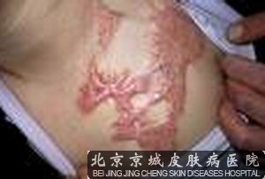 北京治疗瘢痕疙瘩