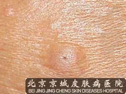 皮脂腺囊肿怎么治疗