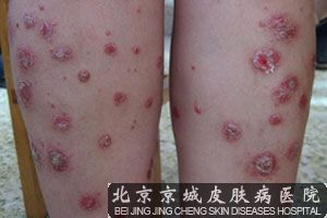 牛皮癣遗传吗