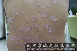 牛皮癣的病因