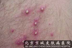 外阴毛囊炎怎么治疗