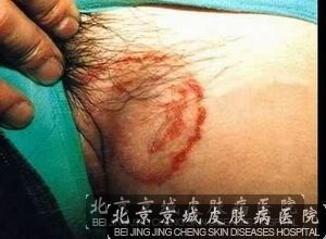 大腿内侧股癣怎么治