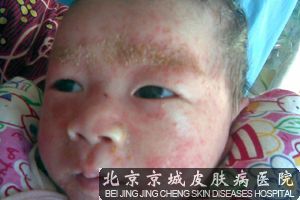 婴儿湿疹的治疗方法及饮食