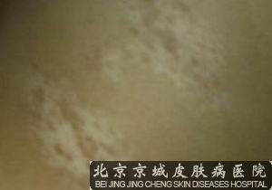 白癜风的治疗方法是什么呢