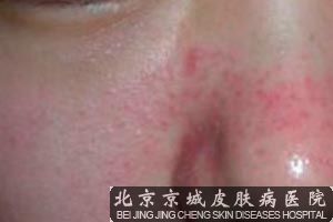 治疗酒糟鼻*好的药有哪些