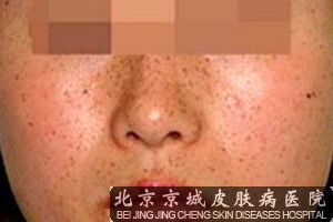 雀斑治疗方法