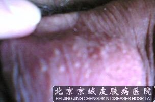 阴囊神经性皮炎