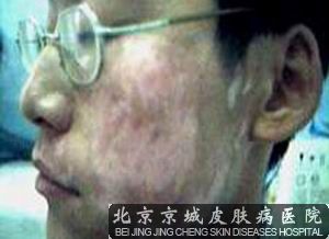 北京治疗白癜风哪家医院好