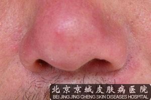 北京哪个医院治疗酒糟鼻好