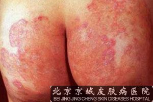股癣是怎么得的