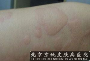 患了荨麻疹会传染吗