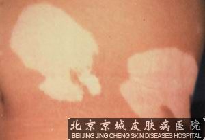 北京治疗酒糟鼻哪家医院好