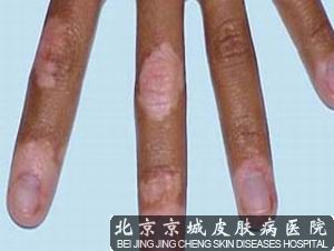 白癜风北京哪家医院好