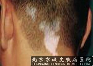 北京治疗白癜风的医院