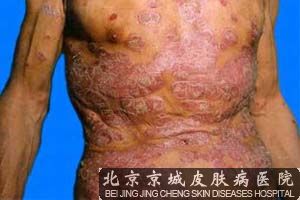 牛皮癣病因