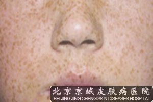 去雀斑*的方法