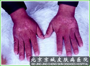 神经性皮炎危害