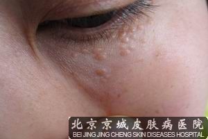 汗管瘤的治疗是什么