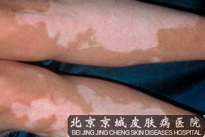 治疗白癜风的偏方