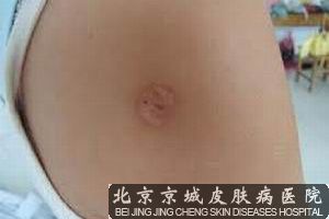 瘢痕疙瘩治疗
