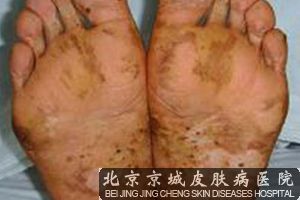 脚气的症状