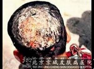 头癣的图片是什么