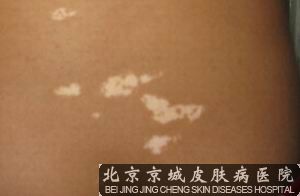 如何治疗白癜风