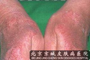 中医治接触性皮炎