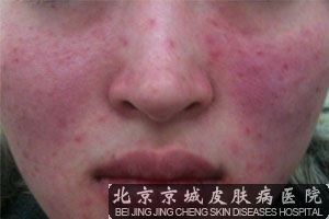 北京治皮炎的医院哪家*好