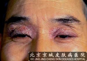 怎样治神经性皮炎