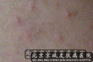 脚气药有哪些