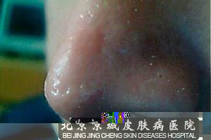 酒糟鼻的治疗