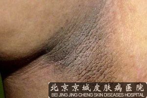 大腿肚内侧变黑怎么回事