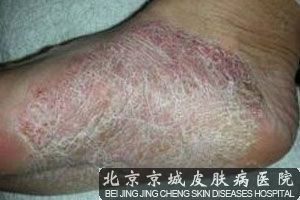 香港脚的治疗方法