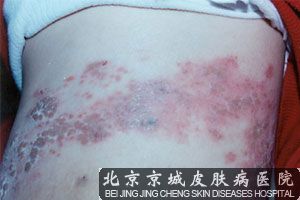 腰上长痘痘怎么回事 - 症状 - 带状疱疹 - 北京京城