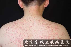 夏天怎么预防毛囊炎