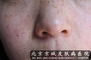 雀斑的形成