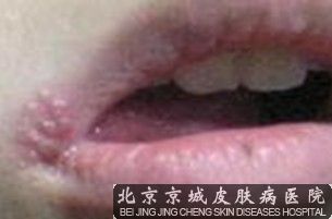 嘴上起水泡怎么办