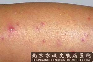 儿童毛囊炎怎么护理