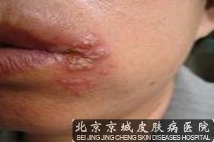 嘴上起泡怎么回事