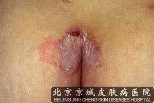 神经性皮炎怎么办
