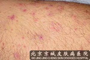 头皮毛囊炎怎么护理