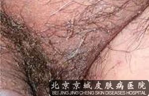 女性阴虱是怎么得的